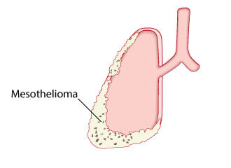 bottom-lung-3