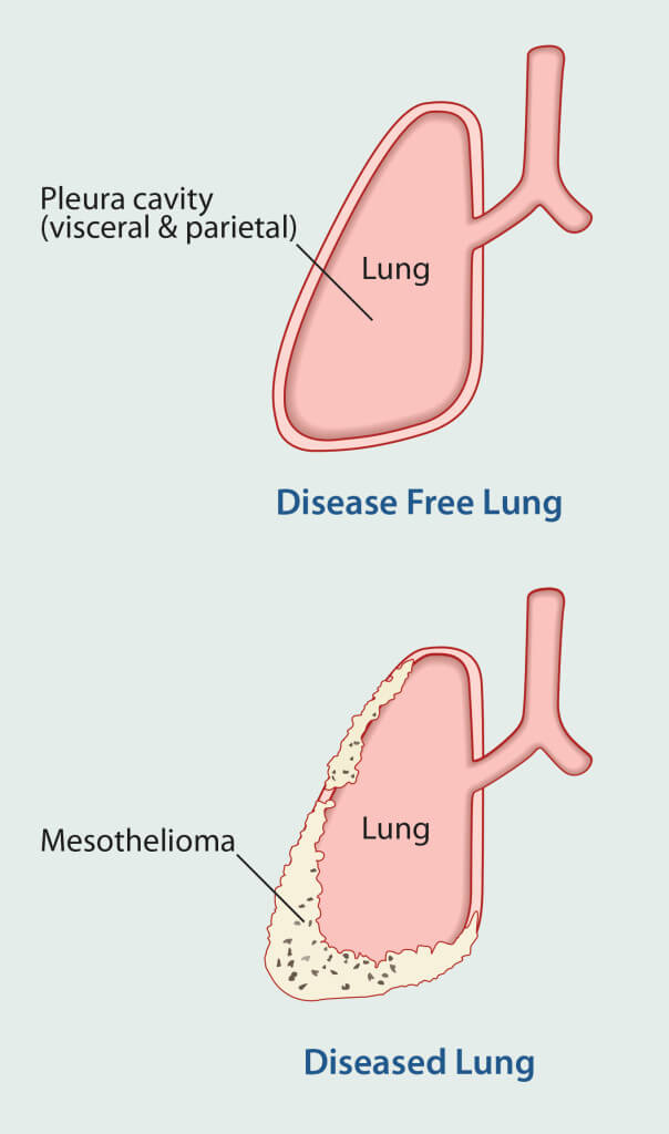 lungs-1