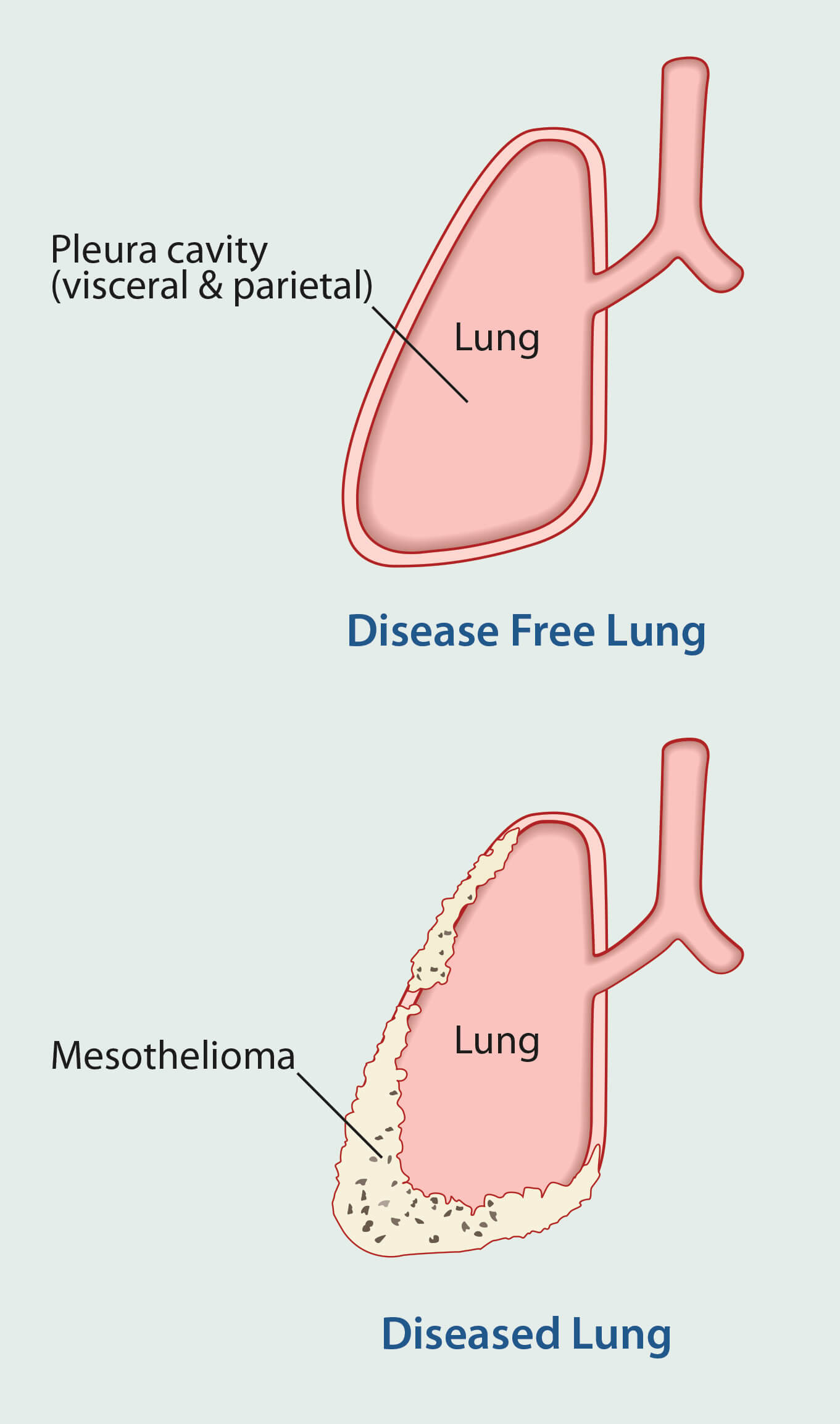 mesothelioma dry mouth