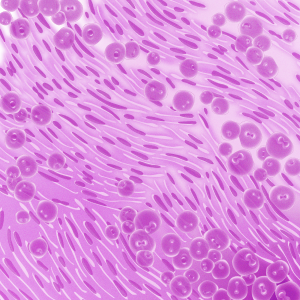 Biphasic mesothelioma cells under a microscope
