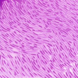 drawing of sarcomatoid mesothelioma cells